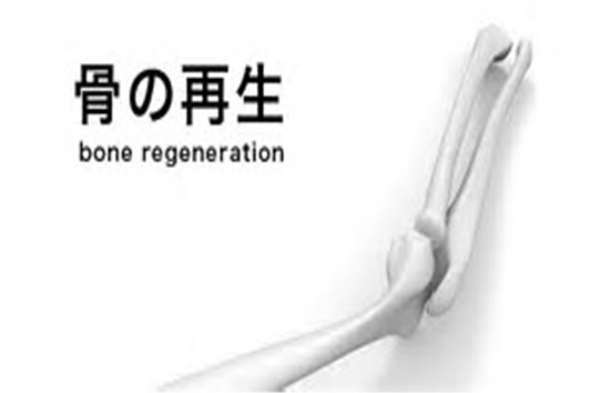 世界首例组织工程再生骨修复大段骨缺损技术获成功