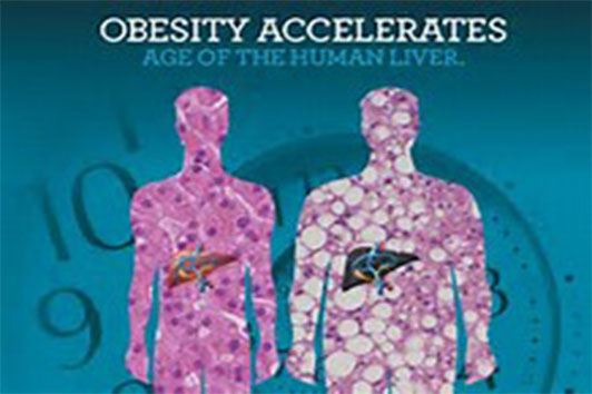 科学家发现新机制，成功逆转脂肪肝
